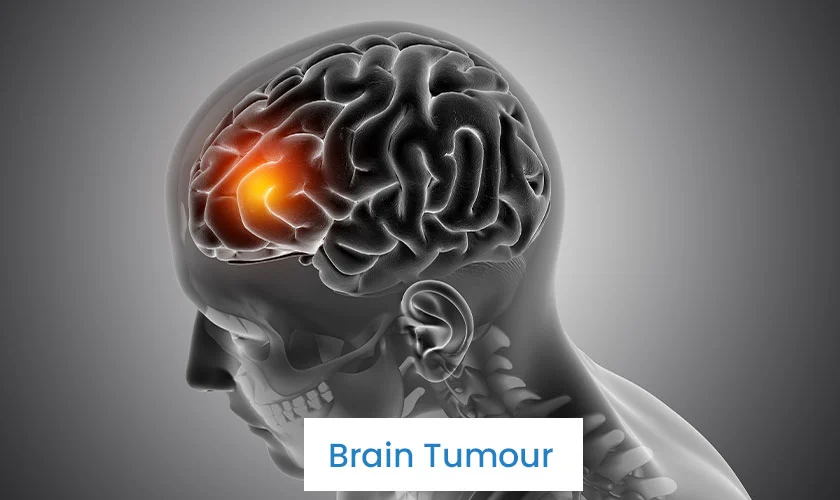 Brain tumour