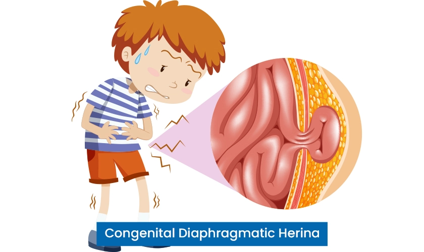 Congenital Diaphragmatic Hernia