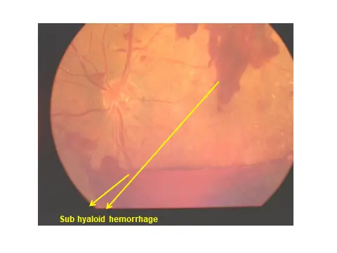 Diabetic Retinopathy