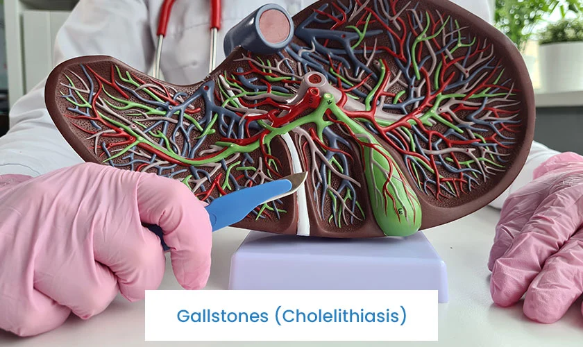 Gallstones (Cholelithiasis)