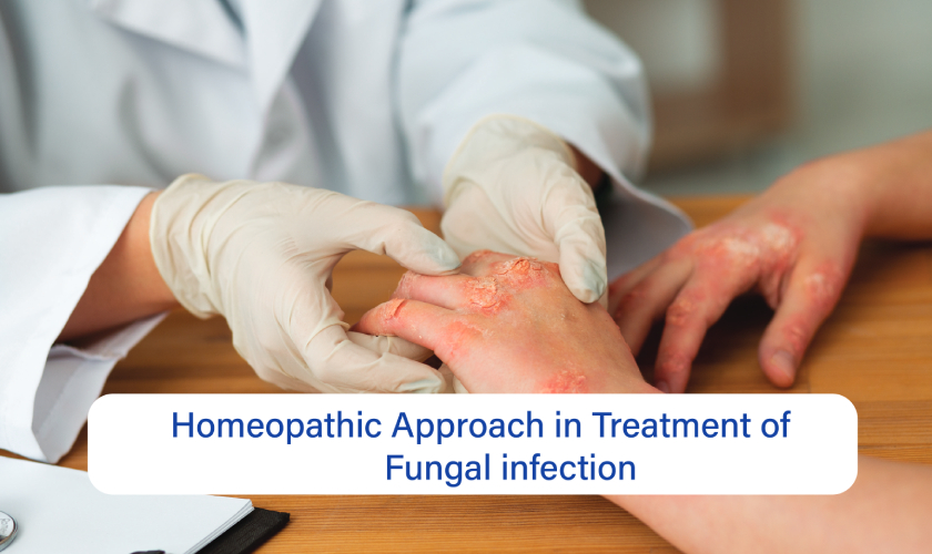 Homoeopathic Approach in Treatment of Fungal Infection