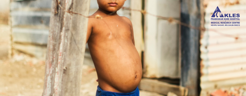 Kwashiorkor