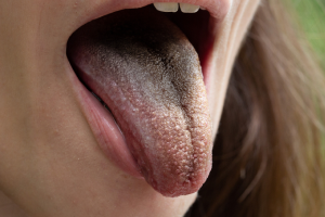 Black Tongue: Causes, Symptoms & Treatment