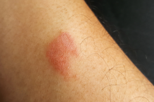 Centipede Bite: Symptoms & First Aid Treatment