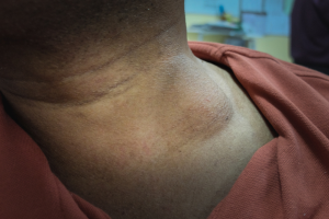 Cystic Hygroma: Causes, Symptoms & Treatment