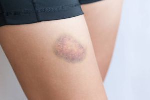 Ecchymosis: Causes, Symptoms & Treatment