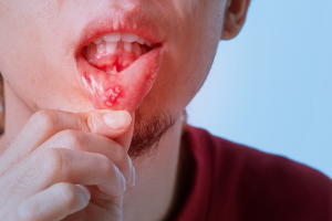 Erythroplakia: Causes, Symptoms & Diagnosis