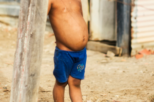 Kwashiorkor: Causes, Symptoms & Treatment
