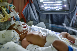 Meconium Aspiration Syndrome: Causes & Treatment