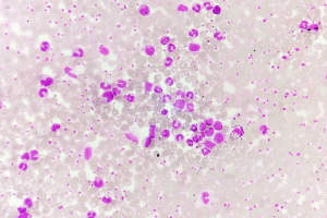 Thrombocytosis: Causes, Symptoms & Treatment