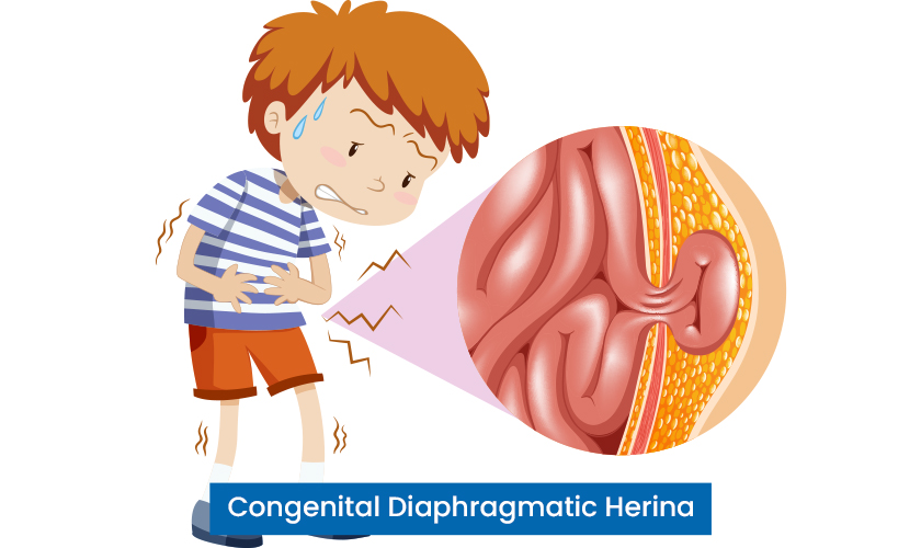 Congenital Diaphragmatic Hernia - Blog By KLE Hospital