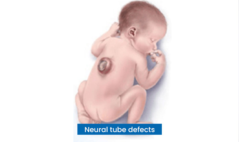 Neural Tube Defects - KLE Hospital Blog