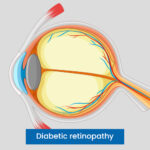 Diabetic Retinopathy - Diagnosis & Treatment