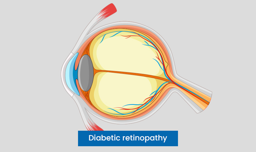 Diabetic Retinopathy - Diagnosis & Treatment
