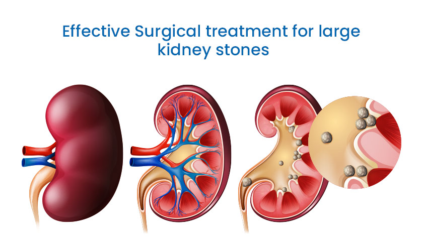 Surgical Treatment for Large Kidney Stones
